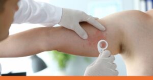 Signs and Symptoms of Monkeypox - urgent care fairfield ct