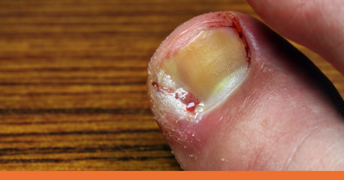 Medical Complications From Toenail Trauma Infection