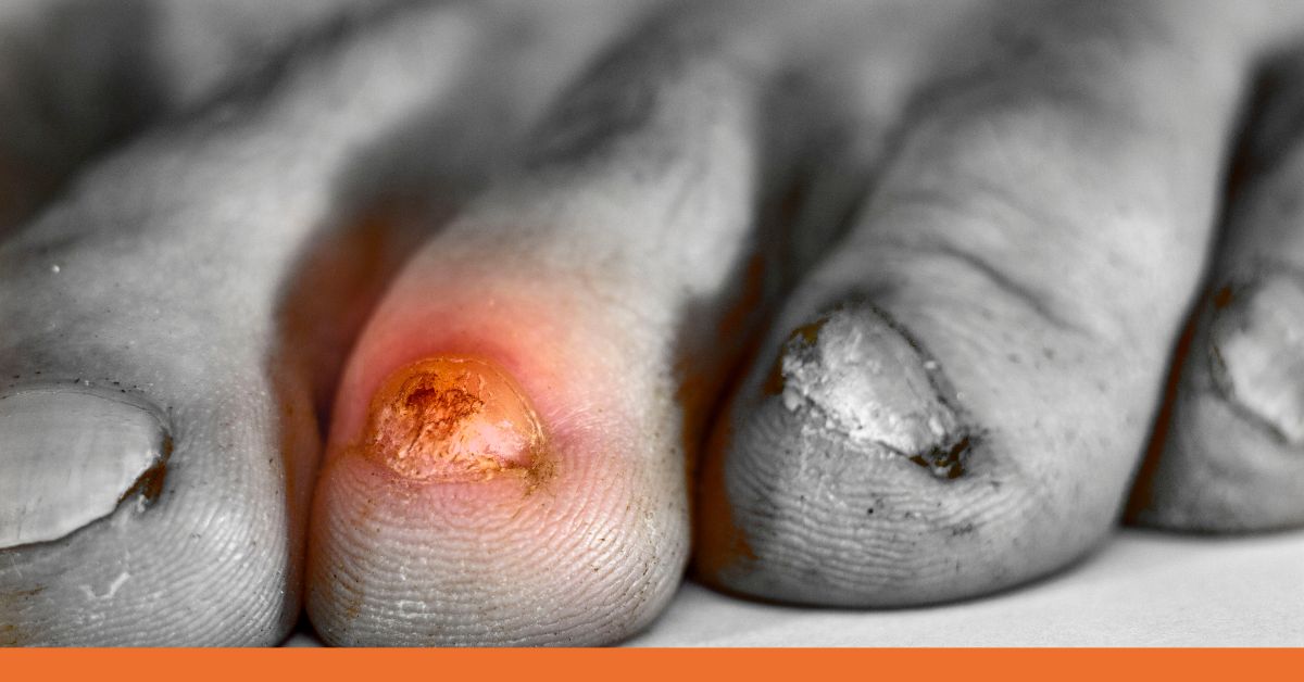 When to Seek Medical Attention for a Toenail Injury