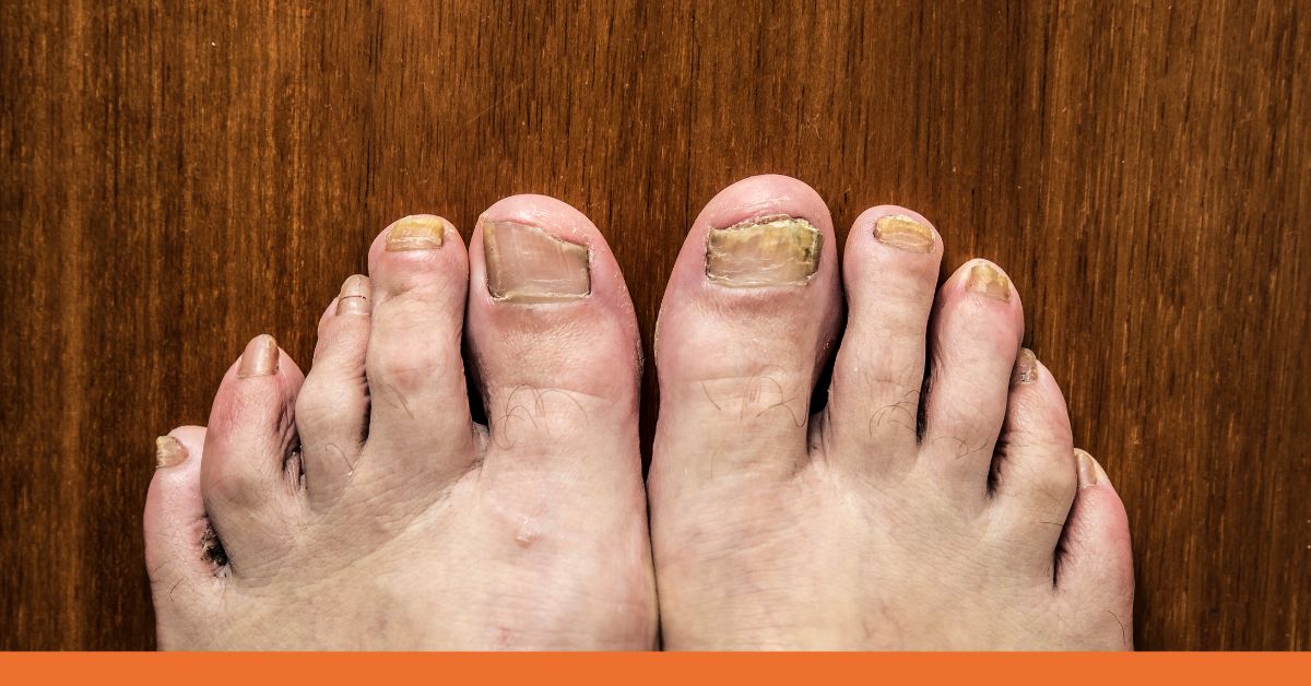 Toenail Injuries  Podiatrists Foot and Ankle Specialists  Diabetic Foot  Care Specialists located in Commack NY  Mayfair Foot Care