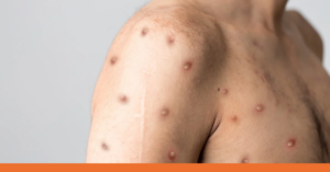Monkeypox Outbreak DOCS Medical Group