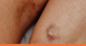 Identifying Different Types of Bruises - DOCS Urgent care – West Hartford