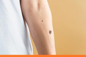 Diagnosing Warts at Urgent Care in West Hartford CT​