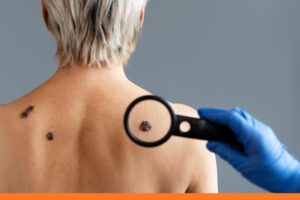 When Should You Visit Urgent Care in West Hartford, CT, For Your Wart?​