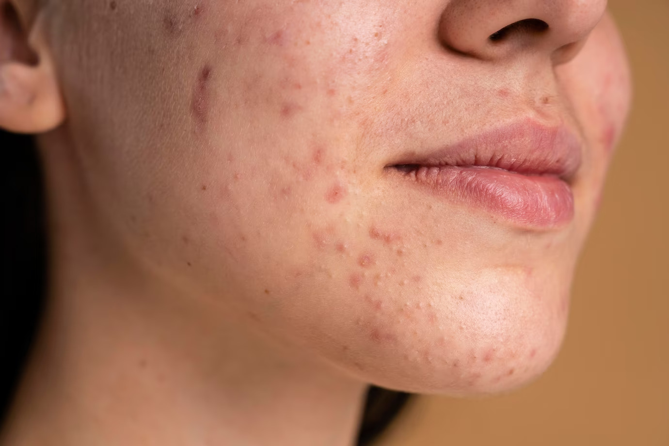 Sudden and Severe Acne Outbreaks
