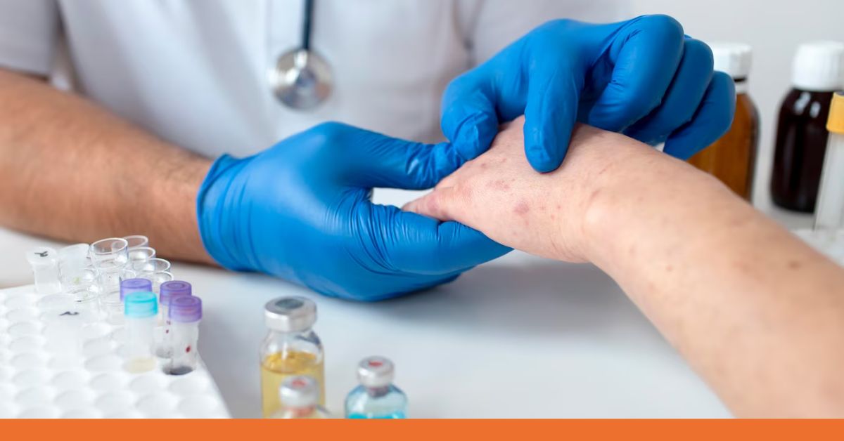 Eczema Self-Care Tips