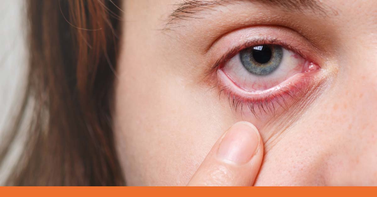 Pink Eye: A Common and Contagious Problem