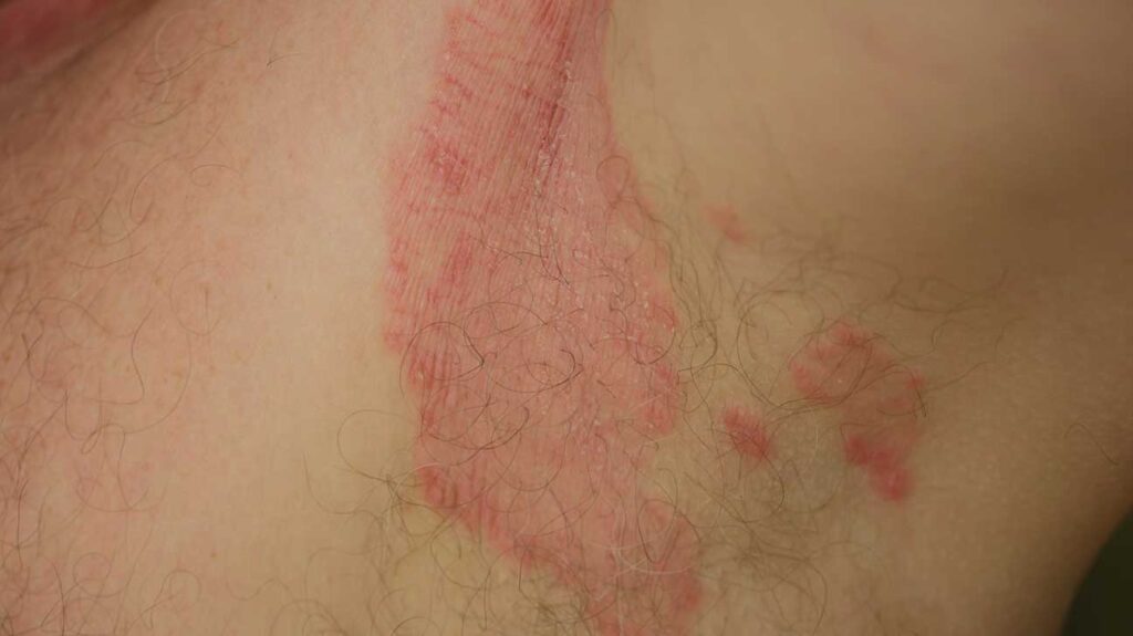 Jock Itch: Symptoms, Treatments, and When to Seek Urgent Care in Southington, CT