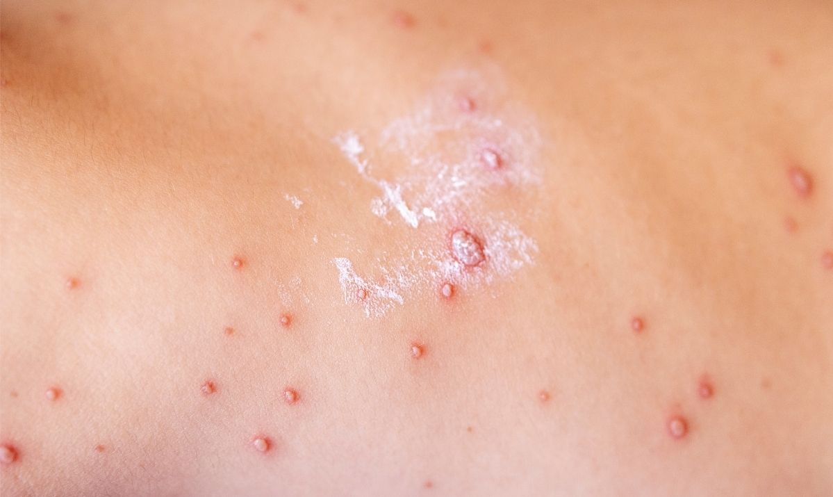 What You Need to Know About the Chickenpox Vaccine