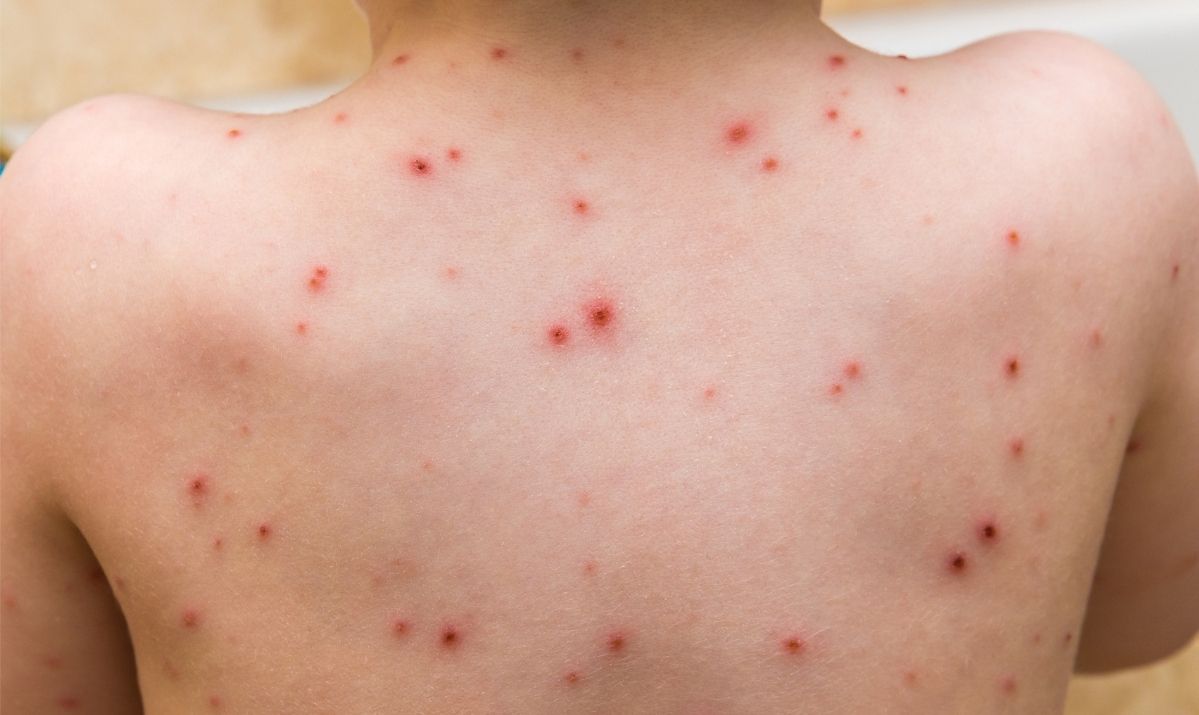 Chickenpox: Symptoms and When to Seek Urgent Care in Fairfield, CT
