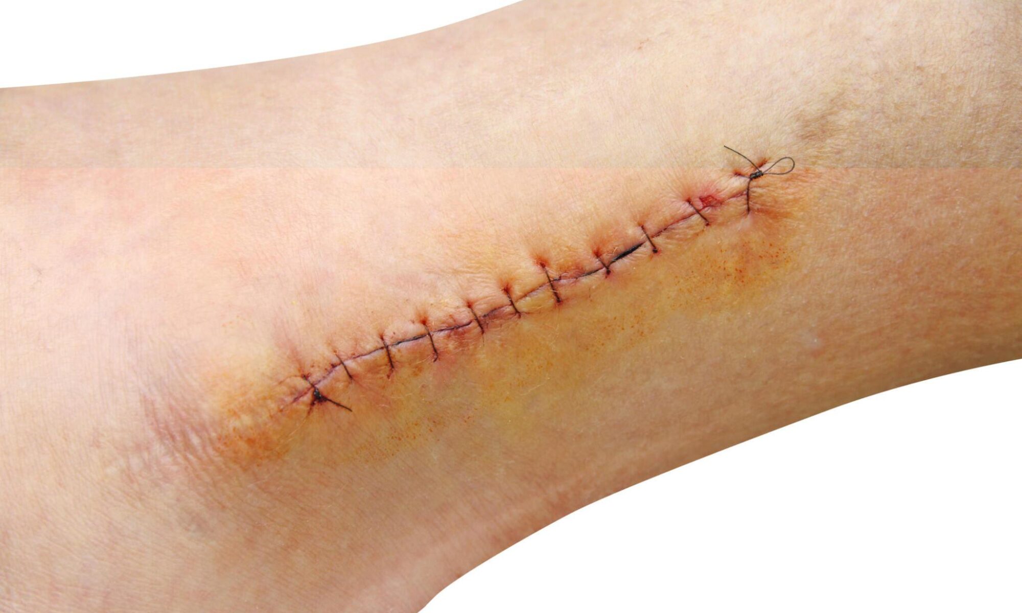 4 Cuts and Wounds that Require Sutures — Trusted Urgent Care in Fairfield, CT