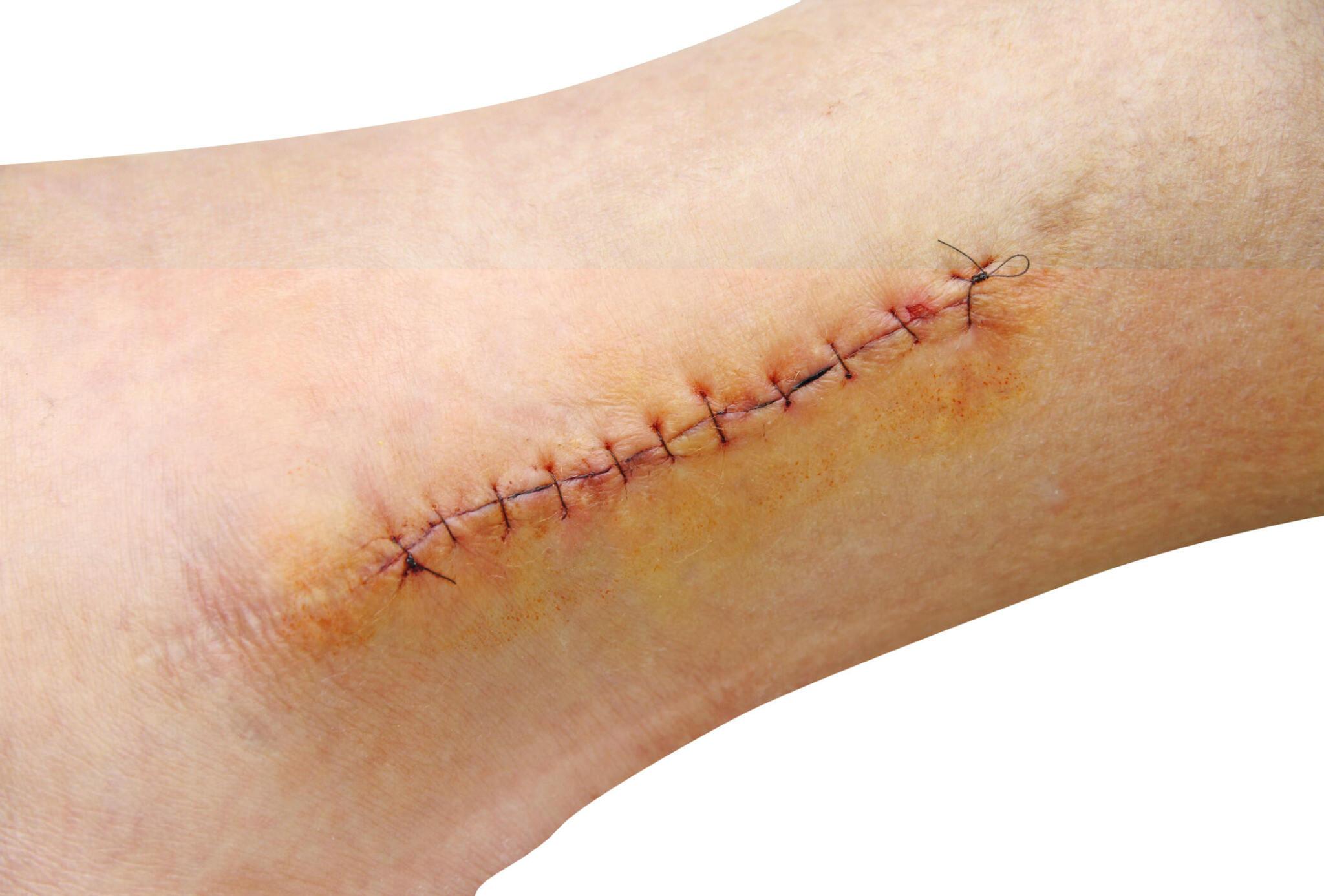 4 Cuts and Wounds that Require Sutures — Trusted Urgent Care in Fairfield, CT