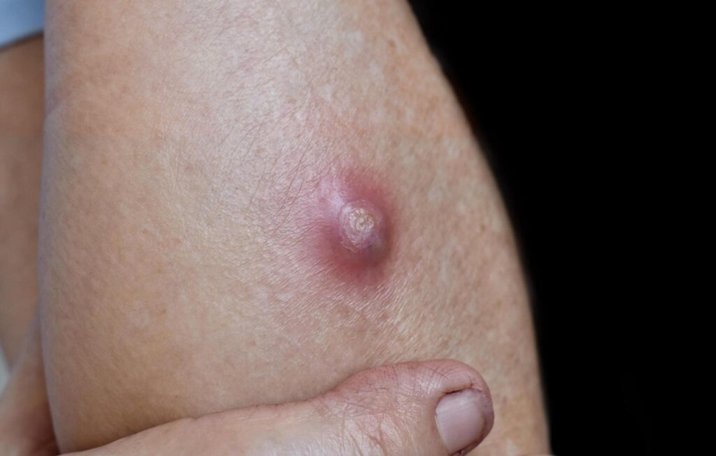 When To Go To Urgent Care in Hartford, CT, for Abscesses
