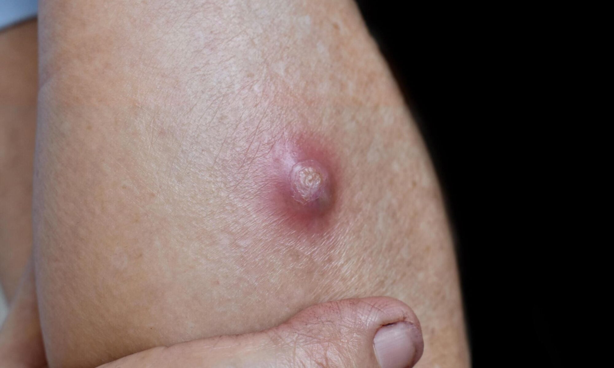 When To Go To Urgent Care in Hartford, CT, for Abscesses