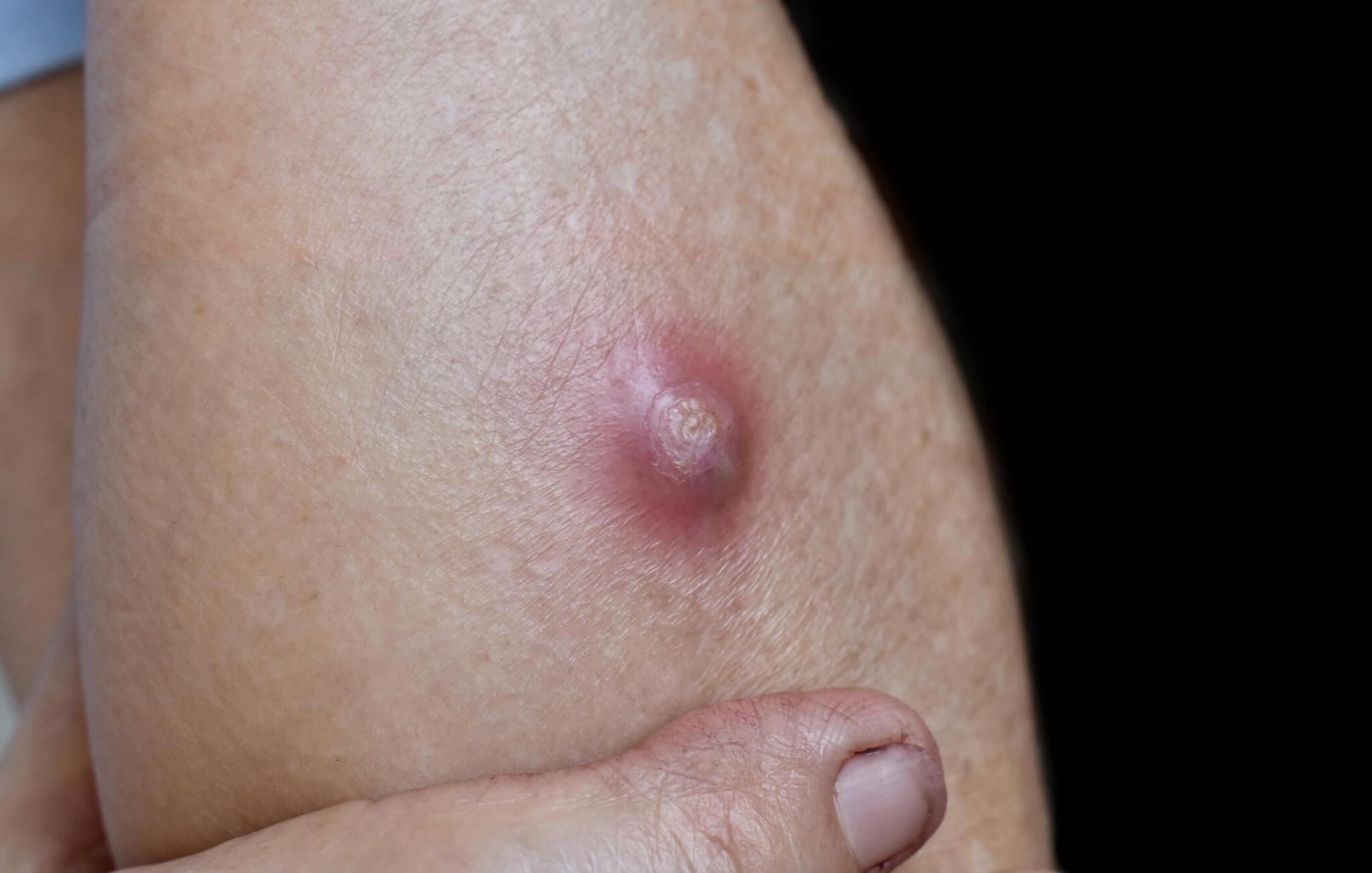 When To Go To Urgent Care in Hartford, CT, for Abscesses