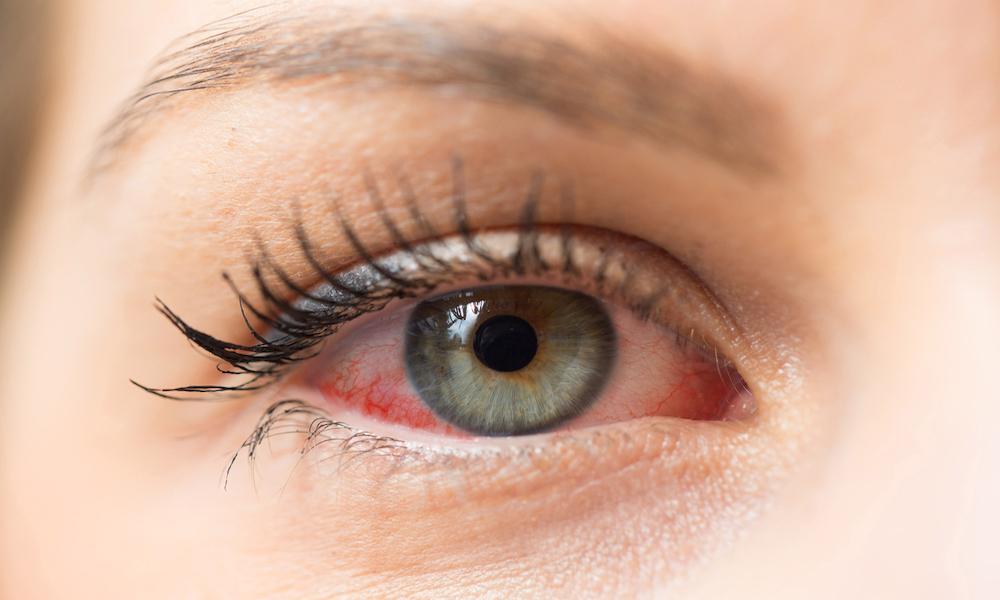 Dry Eyes — Causes, Treatments, and When To Visit a Primary Care Doctor in Southington, CT