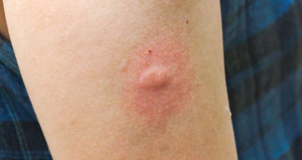 7 Common Causes of Skin Bites and Rashes​