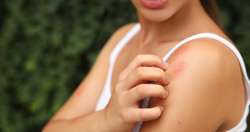 First Aid for Insect Bites