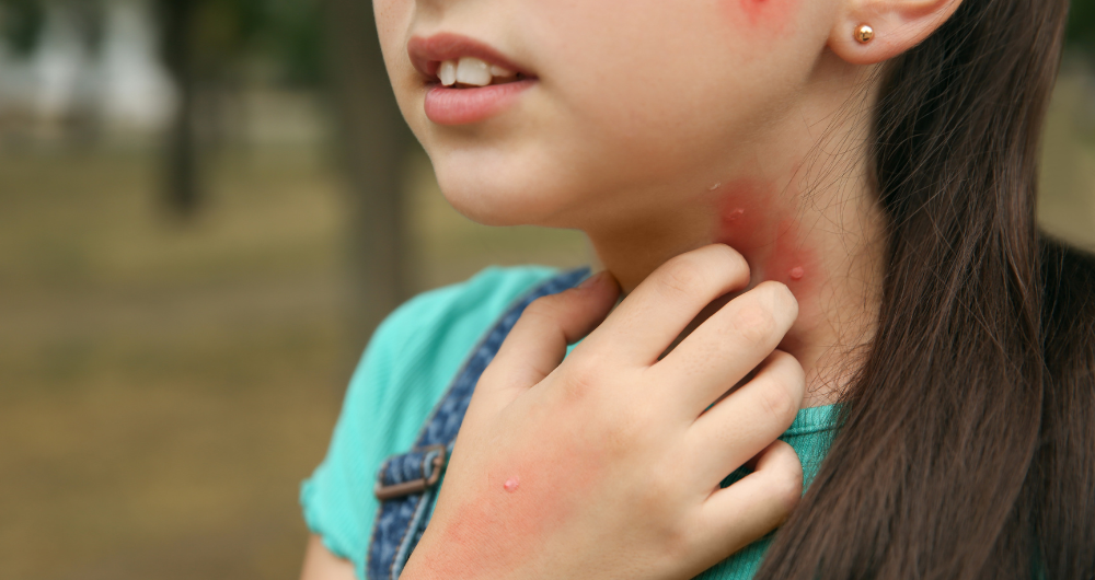 Types of Allergic Reactions to Insect Bites