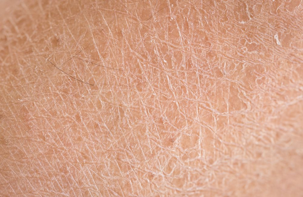 Understanding Dry Skin​