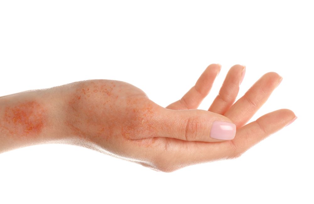 Dry Skin (Xeroderma): Types, Causes, Treatments, and When to Call a Primary Care Doctor in Bridgeport, CT