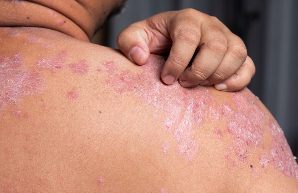 Comparative Overview of Psoriasis and Eczema ​