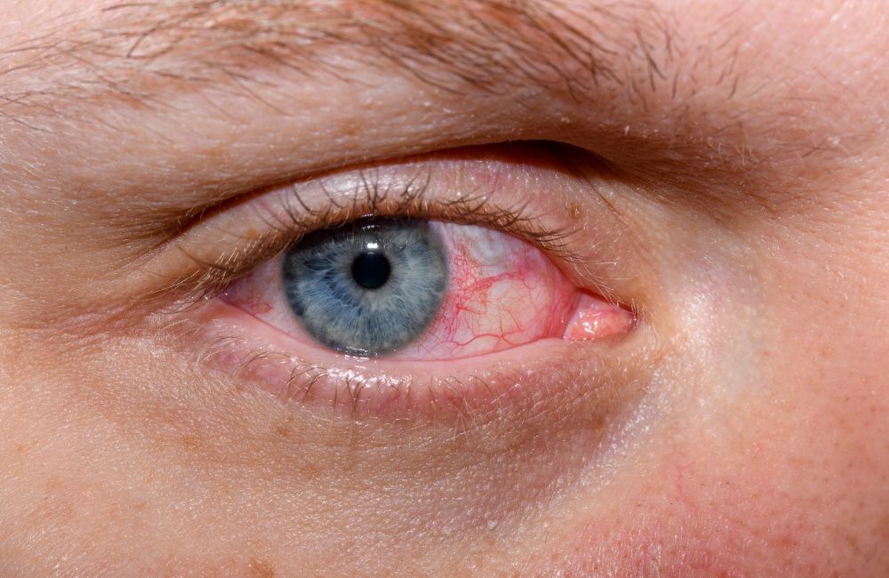 10 Common Causes of Watery Eyes: When to See a Primary Care Doctor in Southington, CT