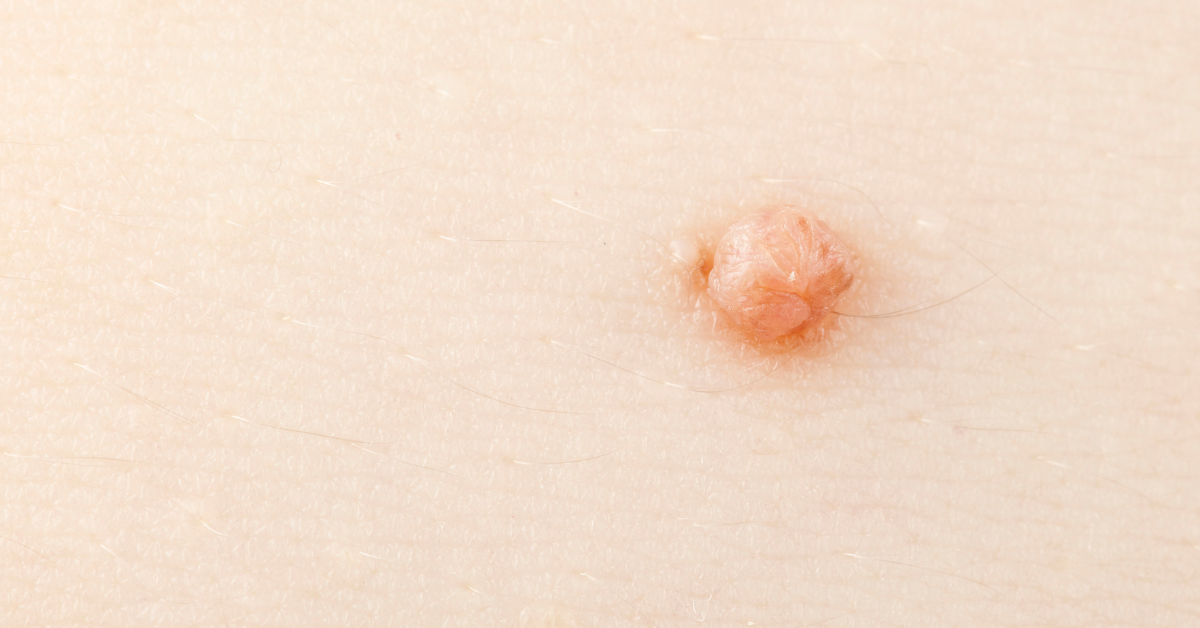 Home Remedies for Managing Warts