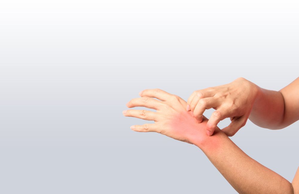 10 Effective Home Remedies for Heat Rashes: When to Seek Help from Urgent Care in Southington, CT