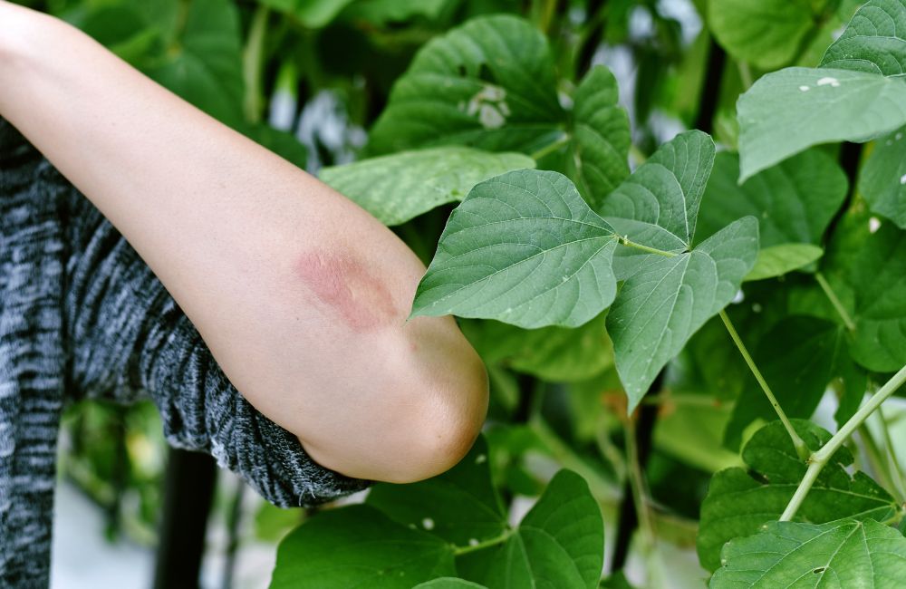 Dealing with Poison Ivy Rashes: Tips from a Primary Care Doctor in Fairfield, CT