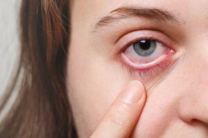Causes of Pink Eye