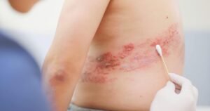 Types of Skin Infections