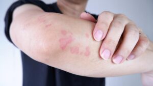 What Causes Skin Infections?