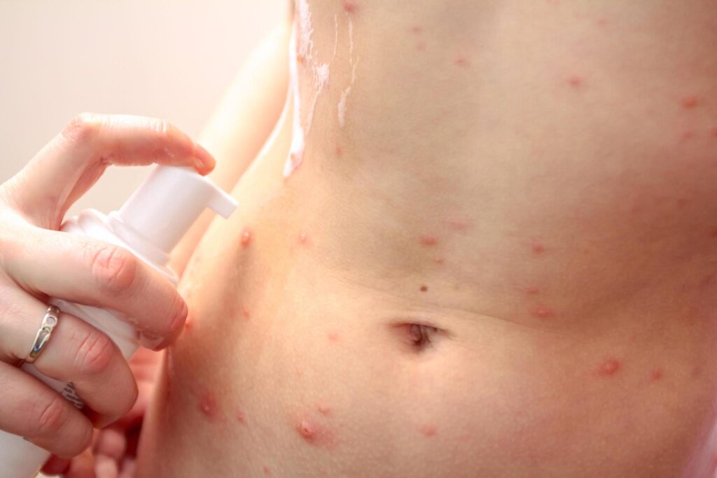 What are the most common types of skin infections treated at urgent care in Stamford, CT?